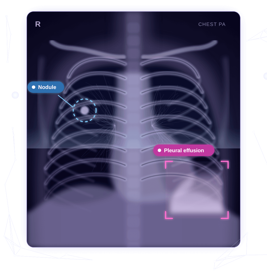 Illustration of Orion CXR marking a nodule and a pleural effusion on a chest X-ray.