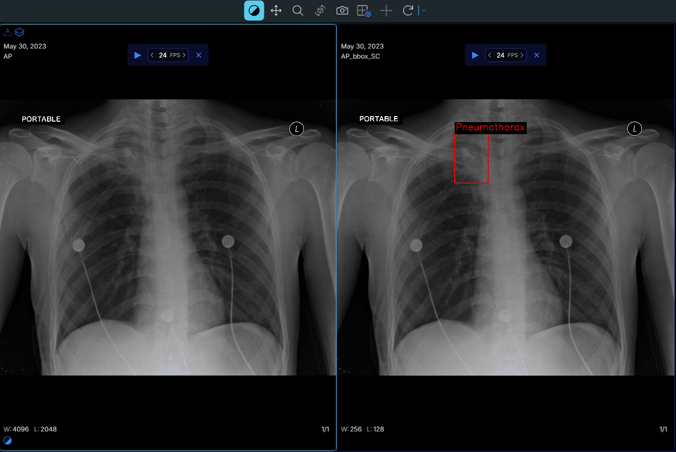 Scaida DICOM viewer showing a chest X-ray next to the same film with an AI box marking a suspected pneumothorax.